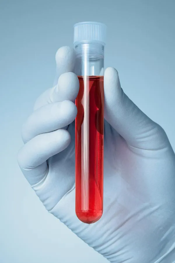 Autoimmune-Treatment A close-up of a doctor's gloved hand holding a vial a plasma, signifying autoimmune disease treatment from Proactive Wellness Centers in Loudoun County.