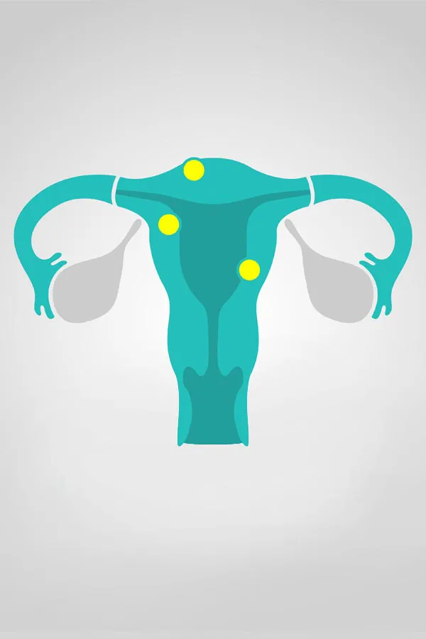 Fibroids-Treatment Illustration of a uterus with yellow dots indicating fibroids. Get treatment for fibroids from Proactive Wellness Centers in Loudoun County.