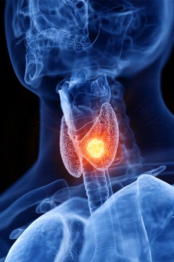 Thyroid-Imbalance-Treatment A 3D illustration of an x-ray of a human neck, highlighting the thyroid. Get help with thyroid imbalance from Proactive Wellness Centers in Loudoun County.