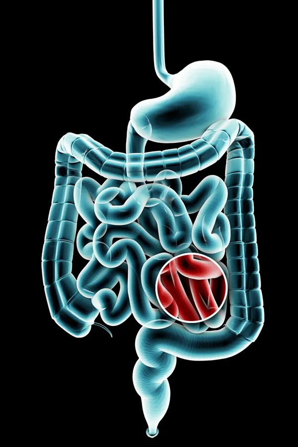 Ulcerative-Colitis-Treatment 3D illustration of the digestive system in blue tones, with an area of discomfort in red tones. Get treatment for Ulcerative Colitis from Proactive Wellness Centers in Loudoun County.